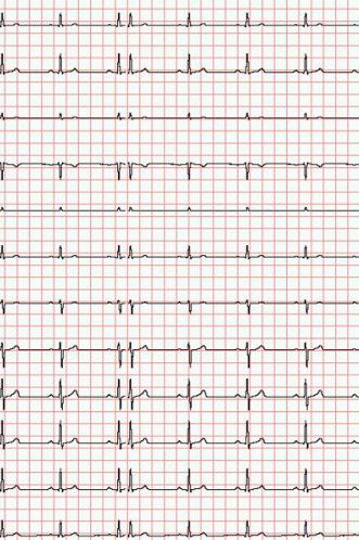 Diagramm Halbach Registrierpapier für EKG Cardio-M-Plus 