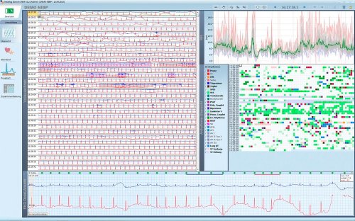 Darwin EKG-Arrhythmie-Analyse für SCHILLER Domino 